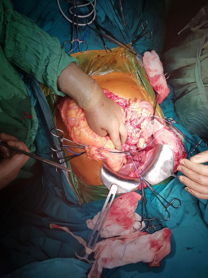 Whipple's Procedure