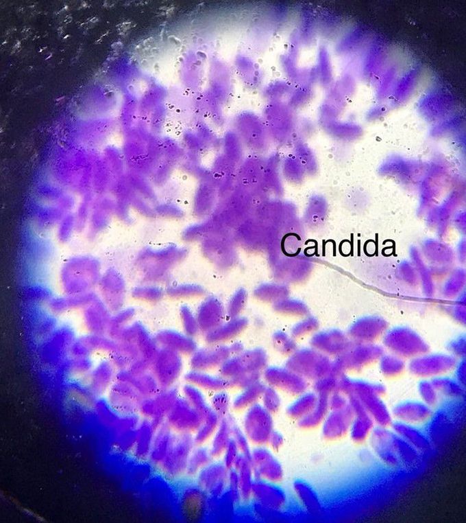 Candida