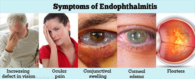 Symptoms of Endophthalmitis