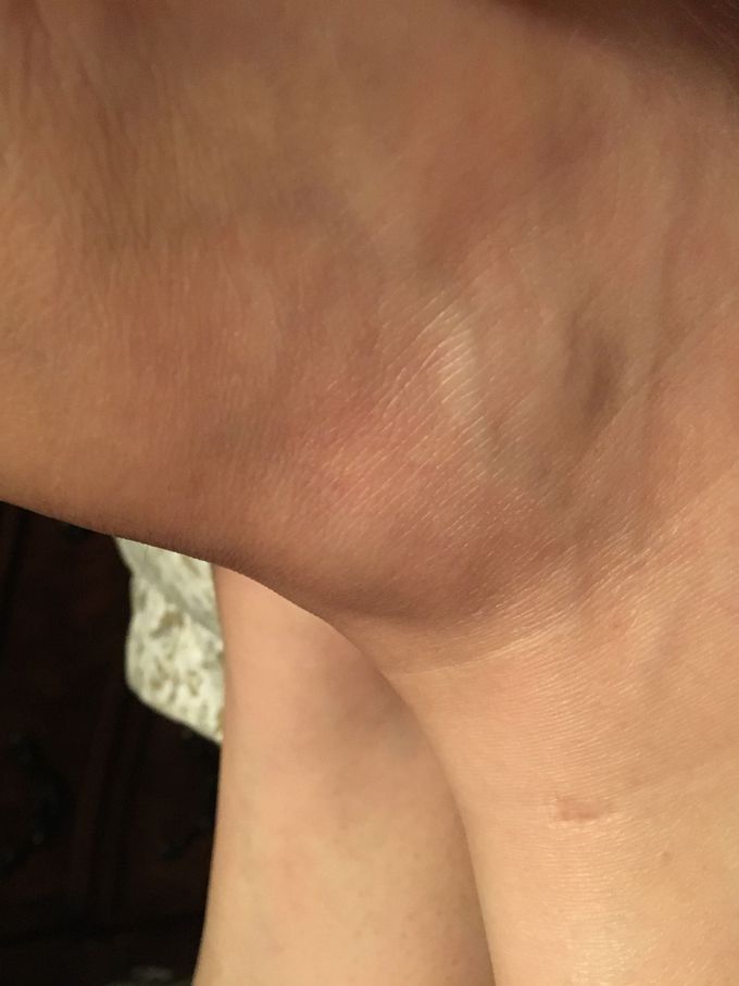 Adema on right ankle on the lateral side