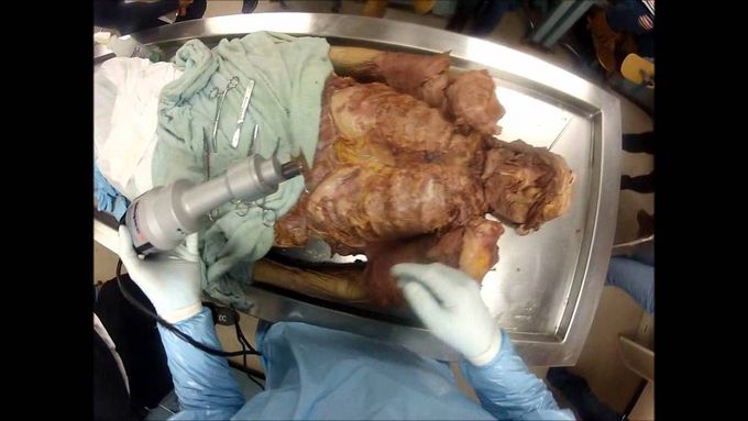 Opening the Thoracic Cavity