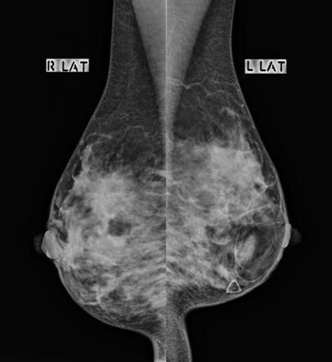Mammography (Lateral)
- “ Breast hamartomas are a benign and uncommon cause of a breast lump.