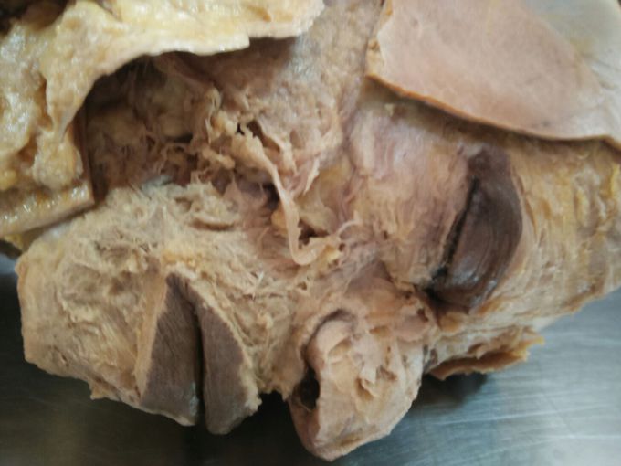 Superfacial view of face.....after dissected