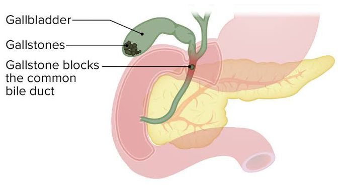 Symptoms of cholelithiasis