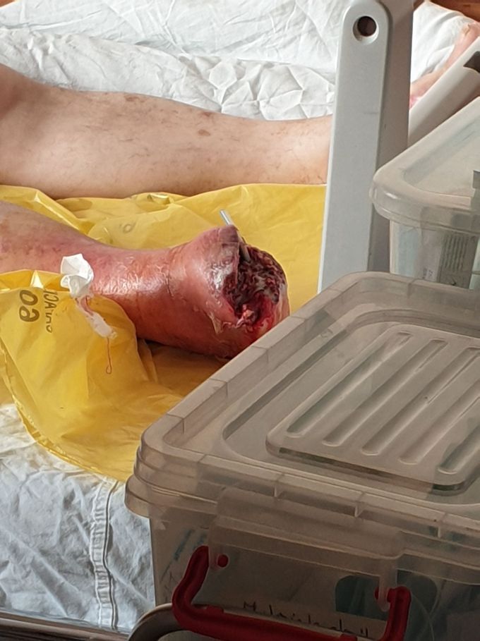 Amputation of the foot Gangrene