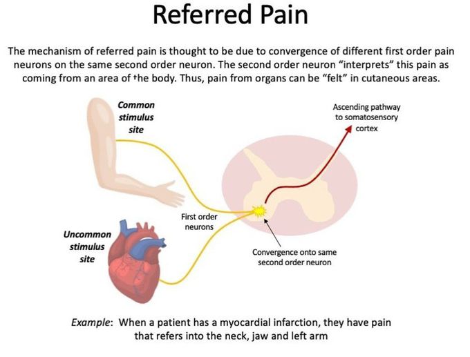 Referred Pain