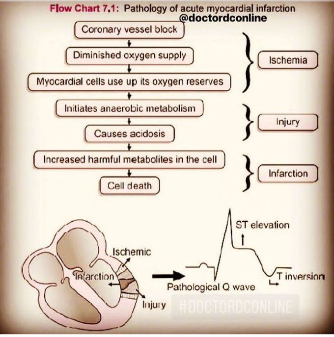 Acute Myocardial Infraction
