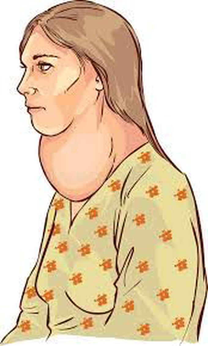 Symptoms of goiter