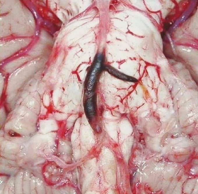 Basilar artery occlusion due to thrombosis