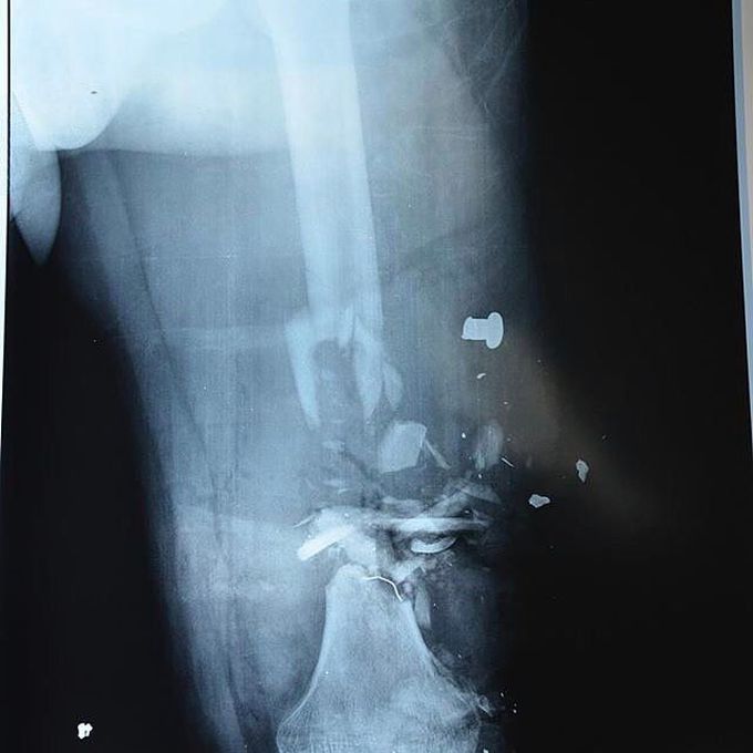 X-ray of a man who suffered a horrific crush injury to his leg