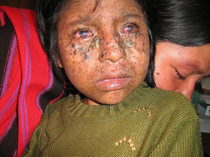 Xeroderma pigmentosum