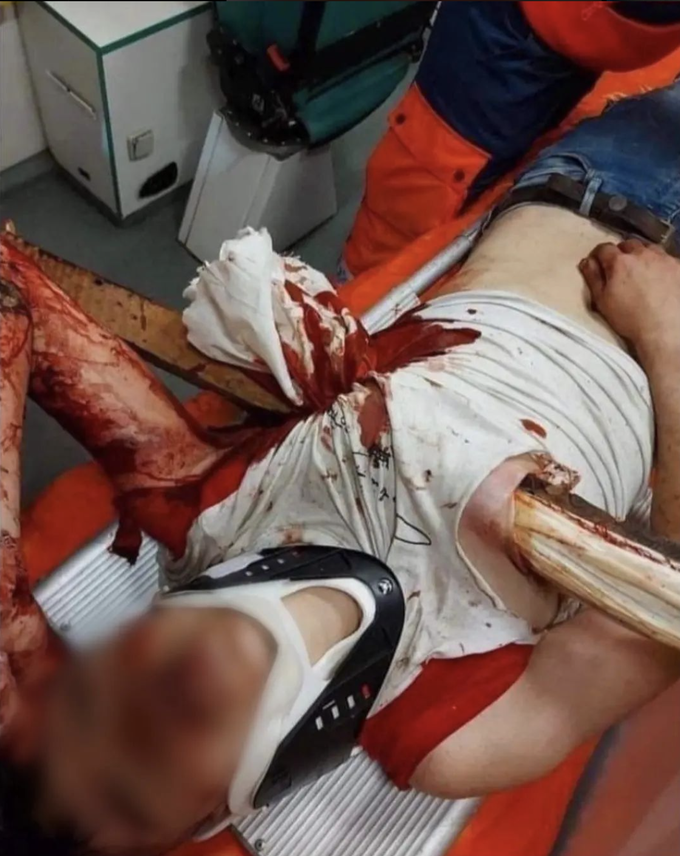 The man manages to survive getting impaled by a pole after a car crash!⁠