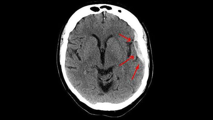 New, Simple Technique for cSDH Cuts Recurrence by 50%
