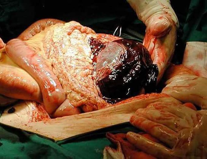 Grade 3 spleen laceration