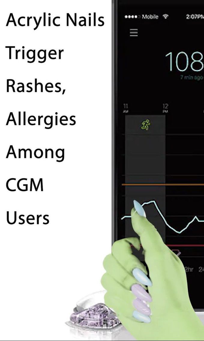 Acrylic Nails Cause Allergies in CGM Users⁠