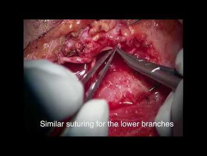 facial nerve cable grafting