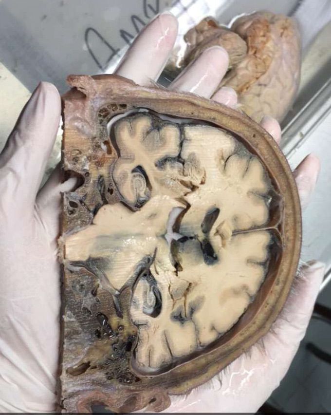 Human brain