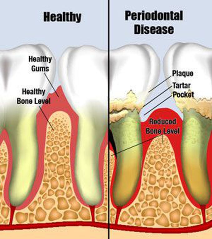 Periodontitis