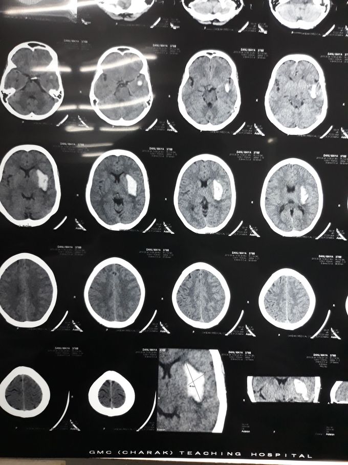 Significance of Siriraj scoring in Stroke? What might be the cause in this presentation?