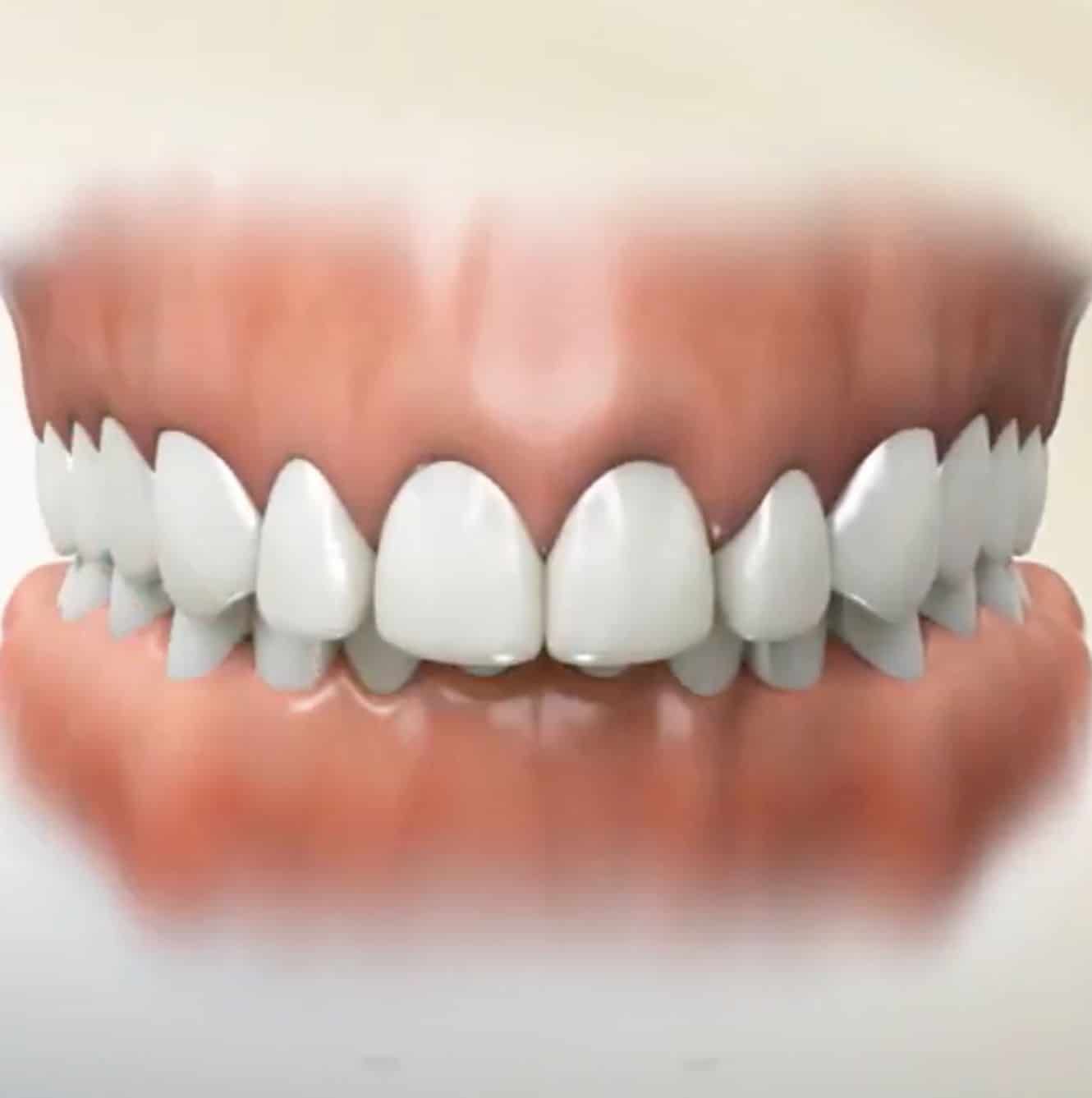 Deep Bite MEDizzy