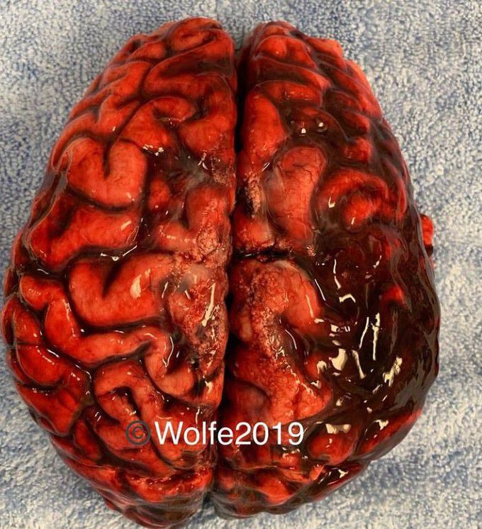 Subarachanoid hemorrhage