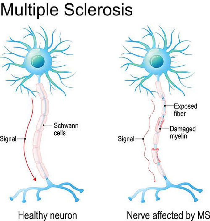 Management of multiple sclerosis