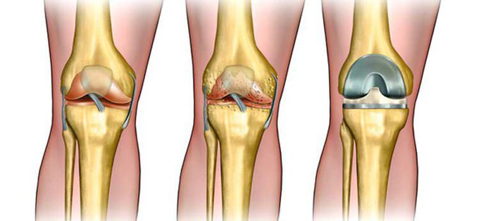Orthopedic Total Joint Replacement