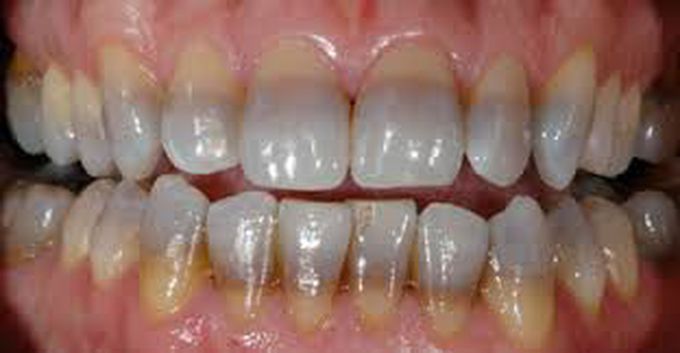 Tetracycline Staining