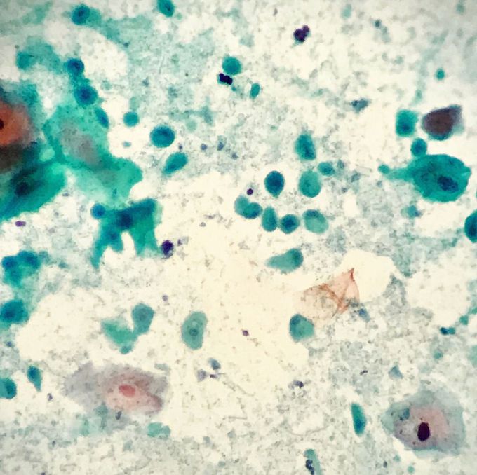 After histological examination what would be your diagnosis ?