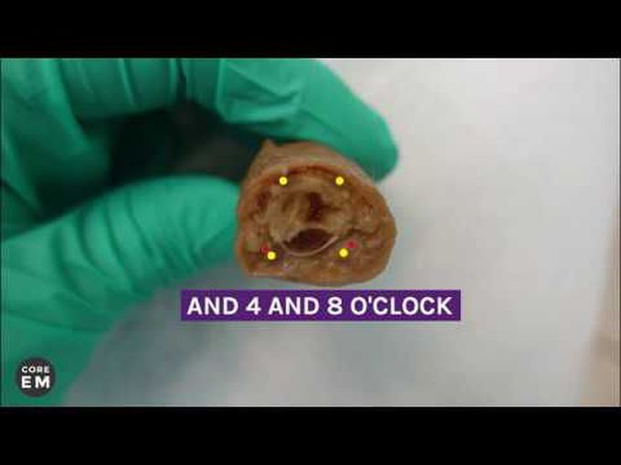 Digital Nerve Block