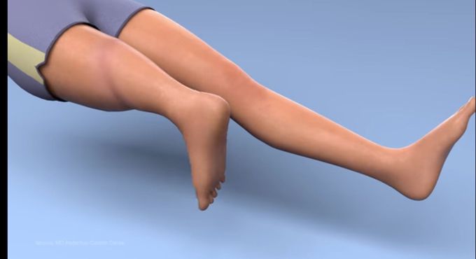 Rotationplasty (Van Nes rotation)