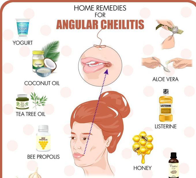 Treatments of Angular cheilitis