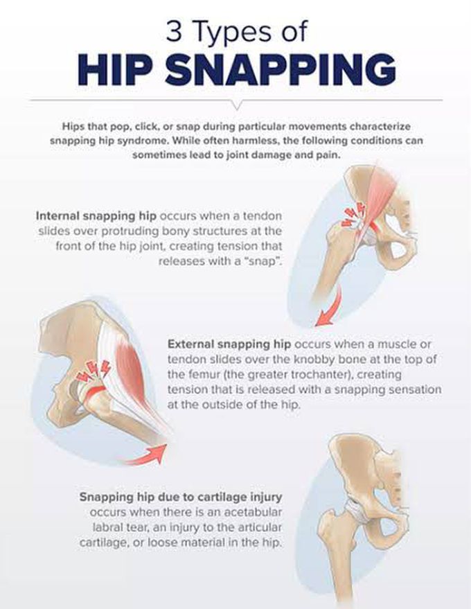 These are the types of Snapping hip syndrome