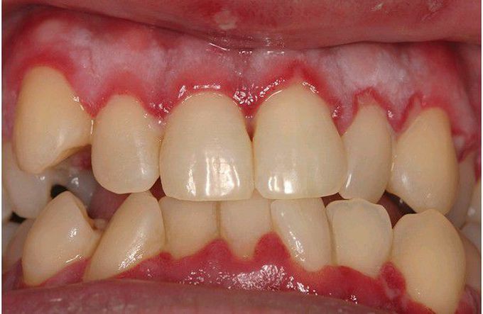 Acute Herpetic Gingivostomatitis