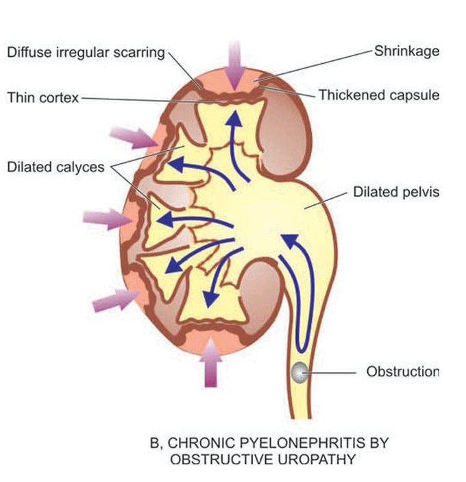 Chronic pyelonephritis