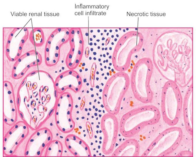 Coagulative necrosis in infarct kidney.