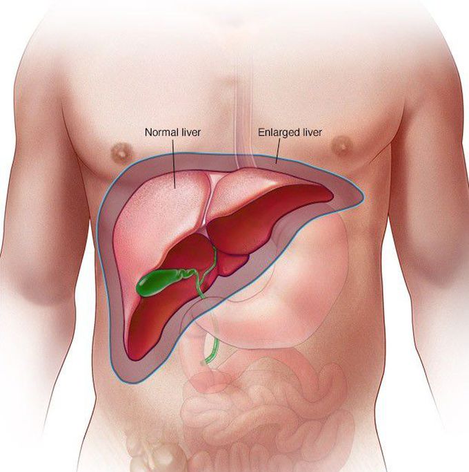 Hepatomegaly