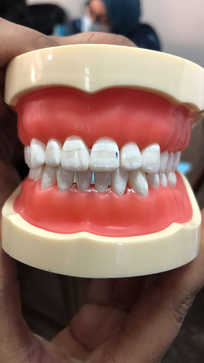 Fluorosis Index