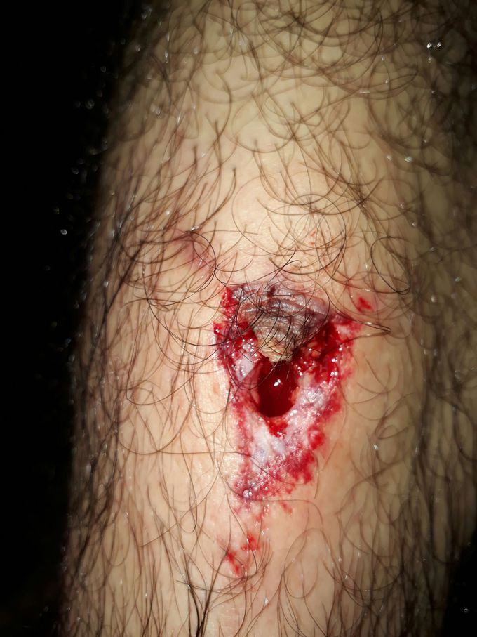 leg injury