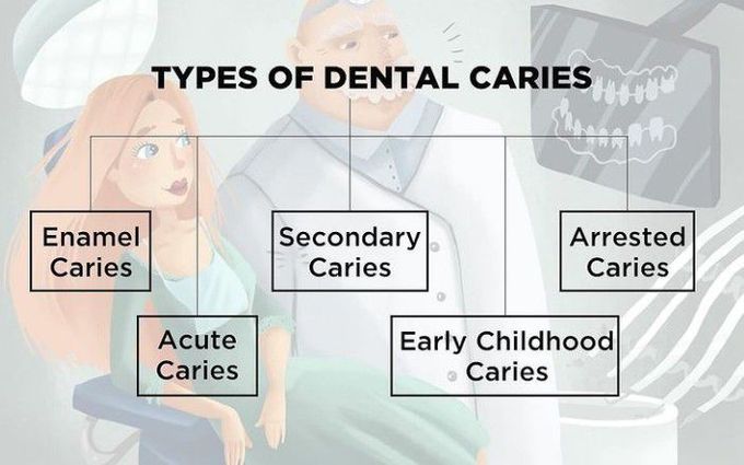 Types of dental carries