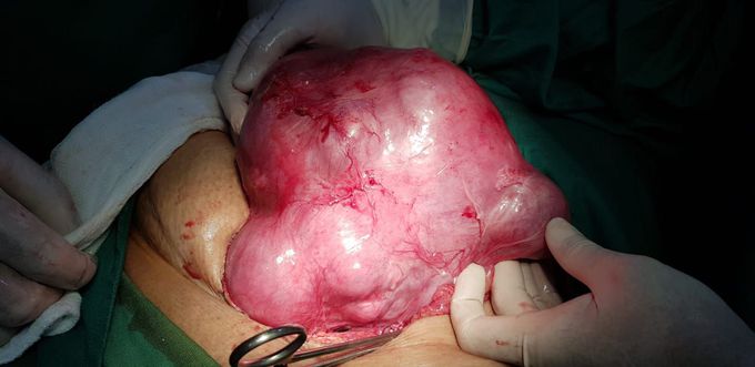 Histerectomía total por miomatosis uterina