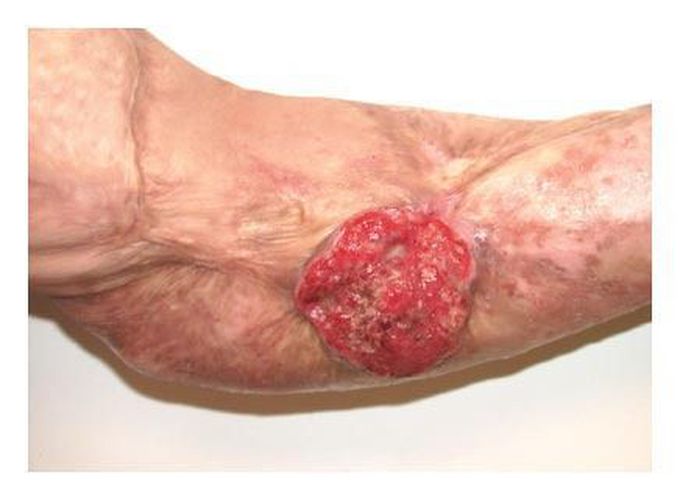 Marjolin's Ulcer