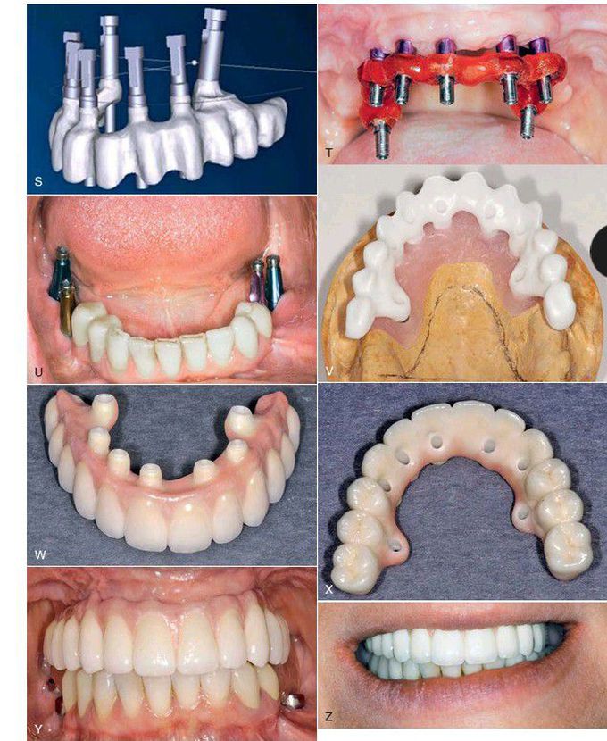 Maxilla rehabilitation