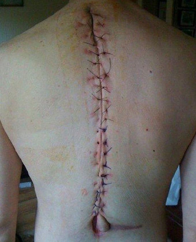 Suturing scar after scoliosis surgery!