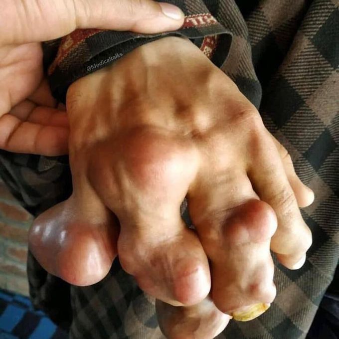 Case of severe gout