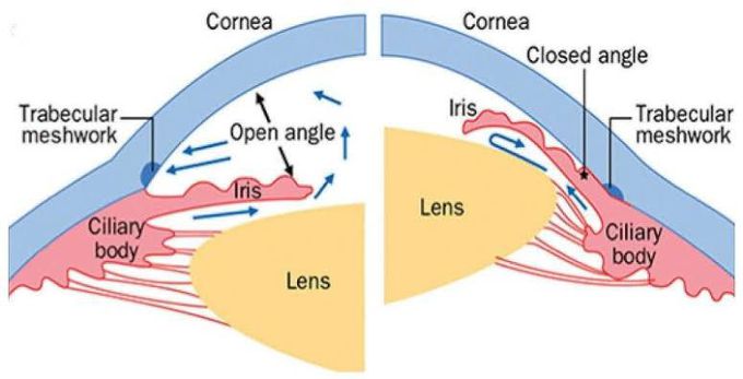Open and closed Angle glaucoma