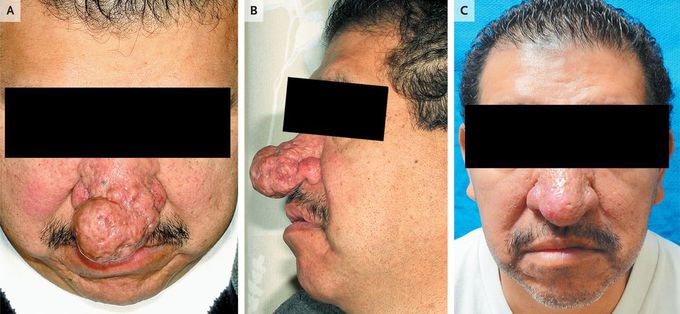 Rhinophyma