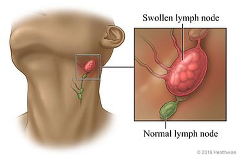 Swollen lymph nodes