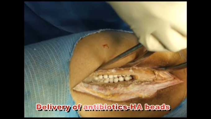 This is a screenshot of osteomyelitis sequesterctomy, in this what is HA beads ?