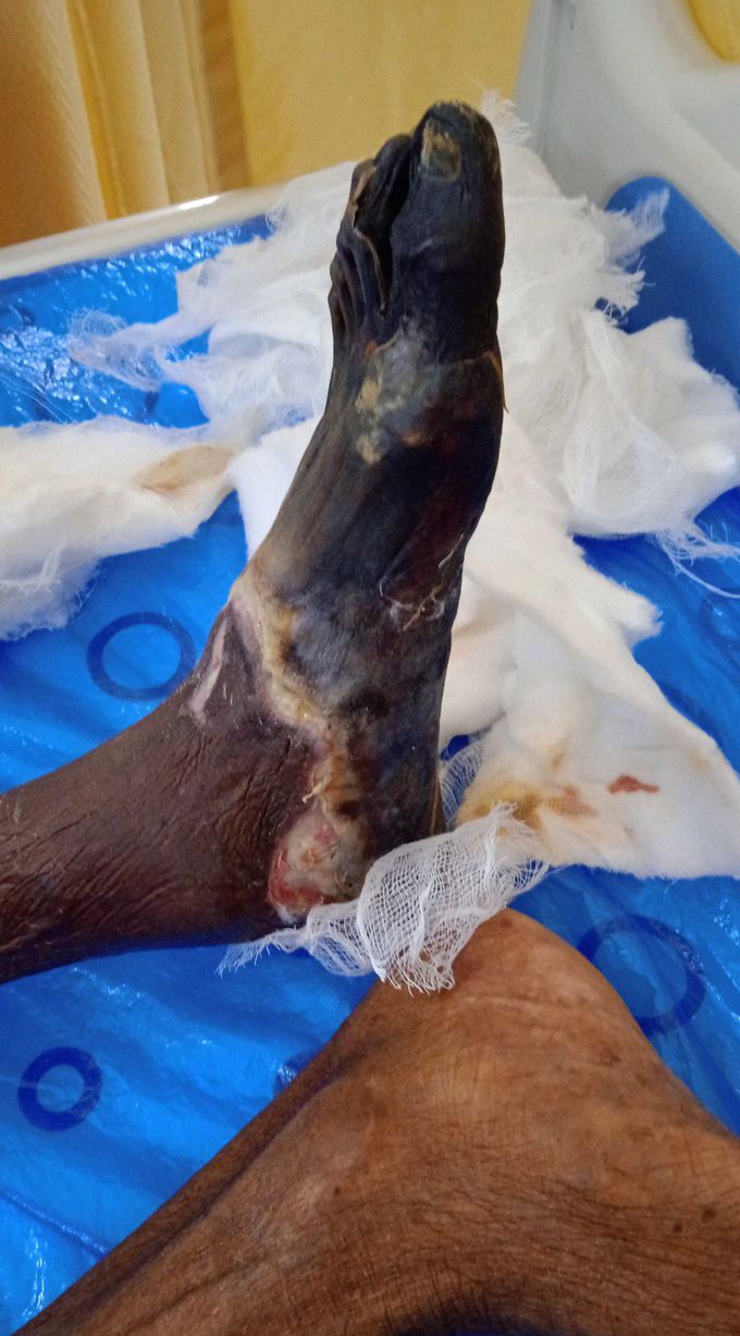 Dry gangrene